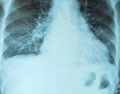 肺积水有肿瘤的症状是什么?