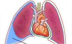 恶性胸腔积液疾病的病因有哪些?怎么快速消除呢?