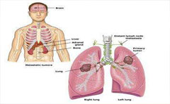 胸腔积液治疗方法